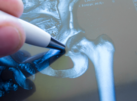 Hémiarthroplastie de la hanche: les prothèses non cimentées de 2e génération presque au niveau des prothèses cimentées