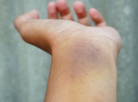 Stollingscontrole bij hemofiliepatiënten: een stand van zaken