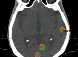 UZ Leuven: nieuwe software voor preciezere bestraling uitzaaiingen in hersenen