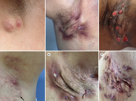 Hidradenitis suppurativa: een heterogene en complexe ziekte waarvoor biotherapie hoop biedt