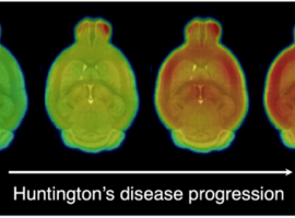 Nieuwe aanpak leidt tot nauwkeurigere diagnose ziekte van Huntington (UA)