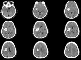 Nut van mini-invasieve chirurgie bij spontane intracerebrale bloeding: de MIND-studie