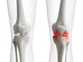 Distraction articulaire du genou: bénéfique pour éviter ou retarder la prothèse totale chez les patients jeunes