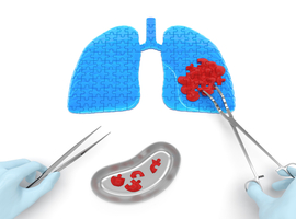 La segmentectomie dans le cancer du poumon non à petites cellules: le bon choix?