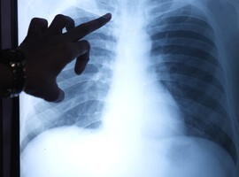 TBC stijgt: incidentie in Brussel drie keer hoger dan nationaal gemiddelde