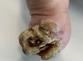 Marjolin-ulcus van de vinger op een oude posttraumatische wond