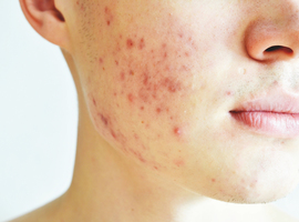 Verband tussen acne en omgevingsfactoren
