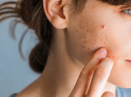 Kenmerken van acne bij volwassen vrouwen