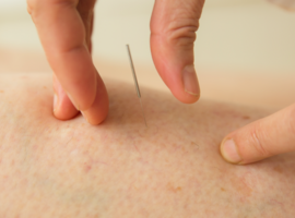 Fin de la loi Colla : les médecins acupuncteurs refusent la « tolérance grise »