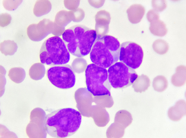 L’étude VIALE-A chez les patients âgés atteints de leucémie myéloïde aiguë
