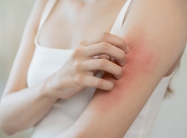 Contactallergie veroorzaakt door glycolen in (“hypo-allergene”) huidverzorgingsproducten en andere consumentenproducten: een toenemende trend?