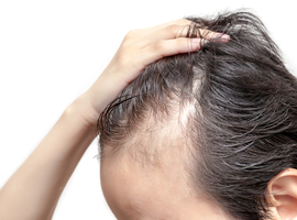 Androgene alopecie: wat te verwachten van de hedendaagse behandeling?