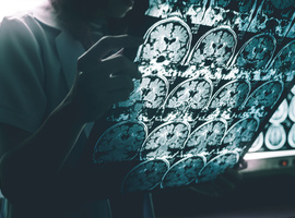 Wetenschappers UCLouvain ontwikkelen mogelijke sleutel om Alzheimer beter op te sporen