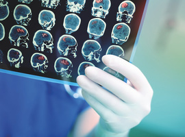Speciale hersenscanner spoort ziekte van Alzheimer in heel vroeg stadium op