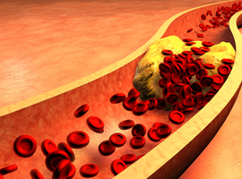 Besoin de stratégies plus personnalisées pour ramener le taux de cholestérol LDL dans les valeurs cibles chez les patients atteints de MCVAS