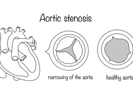 Un TAVI précoce est-il indiqué dans la sténose aortique en l’absence de symptômes?