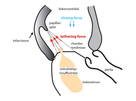 Secundaire mitralisklepinsufficiëntie:  het belang van het subvalvulair apparaat