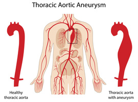 Wat is het major criterium om preventief een aneurysma van de aorta ascendens te opereren?