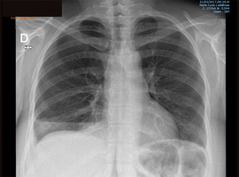 Recidiverende spontane bilaterale pneumothorax