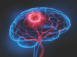 Tumeurs cérébrales: vers une médecine de précision