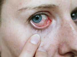 Conjonctivite allergique: pas toujours banale
