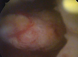 Une complication rare après la résection de résidu placentaire par hystéroscopie à la suite d’un avortement provoqué