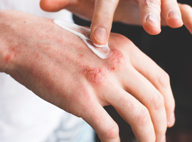 Dermatite de contact allergique due à des médicaments topiques