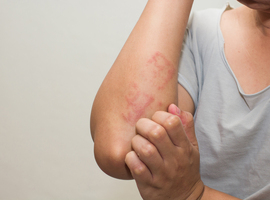 Utilisation d’immunomodulateurs chez les adultes et les adolescents atteints de dermatite atopique modérée à sévère