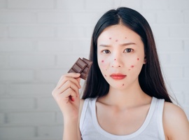 Welke invloed heeft voeding op acne?