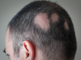 Nieuwe mogelijkheden voor de behandeling van alopecia areata