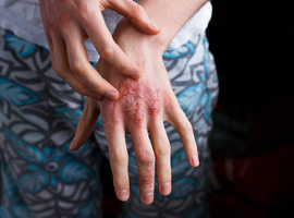 Nouveaux traitements de la dermatite atopique
