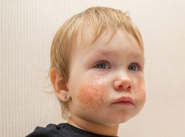 Un granulome facial aseptique idiopathique atypique