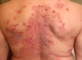 Bevestiging van de werkzaamheid van rituximab als eerstelijnsbehandeling voor pemphigus foliaceus 