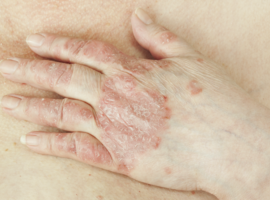 Psoriatische artritis en huidletsels