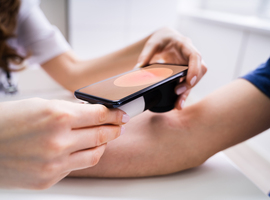 Hoe nuttig zijn telefoonapps in de dermatologie?