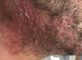 Tinea incognito: un défi diagnostique et thérapeutique