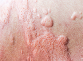 Evidence of microcirculatory involvement in well-established and newly emerging inflammatory skin diseases with autoimmune signature