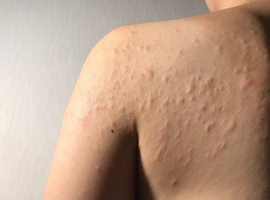 Een klinisch overzicht van contacturticaria