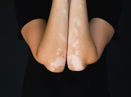 Wie roept de afweercellen naar de huid bij vitiligo?
