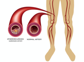 Chronische nierinsufficiëntie en atheromatose van de onderste ledematen