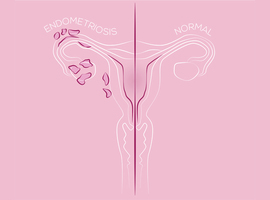 Endometriose en medisch begeleide voortplanting: een bewogen topic