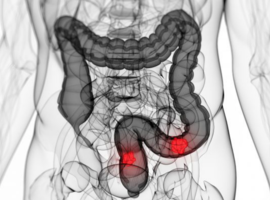 Microbioom en colorectale kanker: een stand van zaken