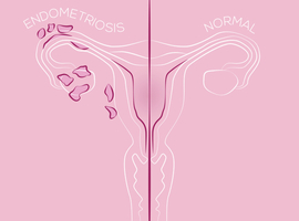 Endometriose: er komt geen einde aan de pijn…