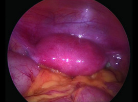 Uterus septatus