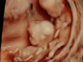 Prenatale test voor Down-syndroom ook bij tweelingen betrouwbaar