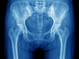 Service d’orthopédie-traumatologie: Les ostéotomies tibiales hautes dans la gonarthrose désaxée de la hanche: Expérience Congolaise