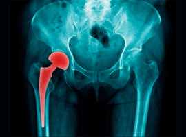 Service d’orthopédie-traumatologie: Inégalité de longueur des membres après arthroplastie de la hanche: prévention et traitements