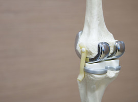 Patiënten betalen veel voor gebruikt materiaal van knieprothese