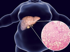 Interactions entre le syndrome métabolique et la consommation d’alcool sur le risque de maladie du foie