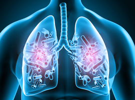 Infections pulmonaires à mycobactéries atypiques (NTM-PD): des présentations cliniques atypiques*